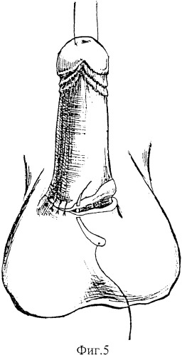 Способ высвобождения кавернозных и спонгиозного тел и удлинения видимой части ствола полового члена (патент 2350284)