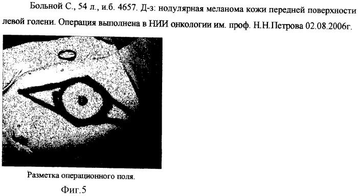 Способ сочетанного закрытия дефекта кожи местными тканями и свободными кожными лоскутами (патент 2326609)