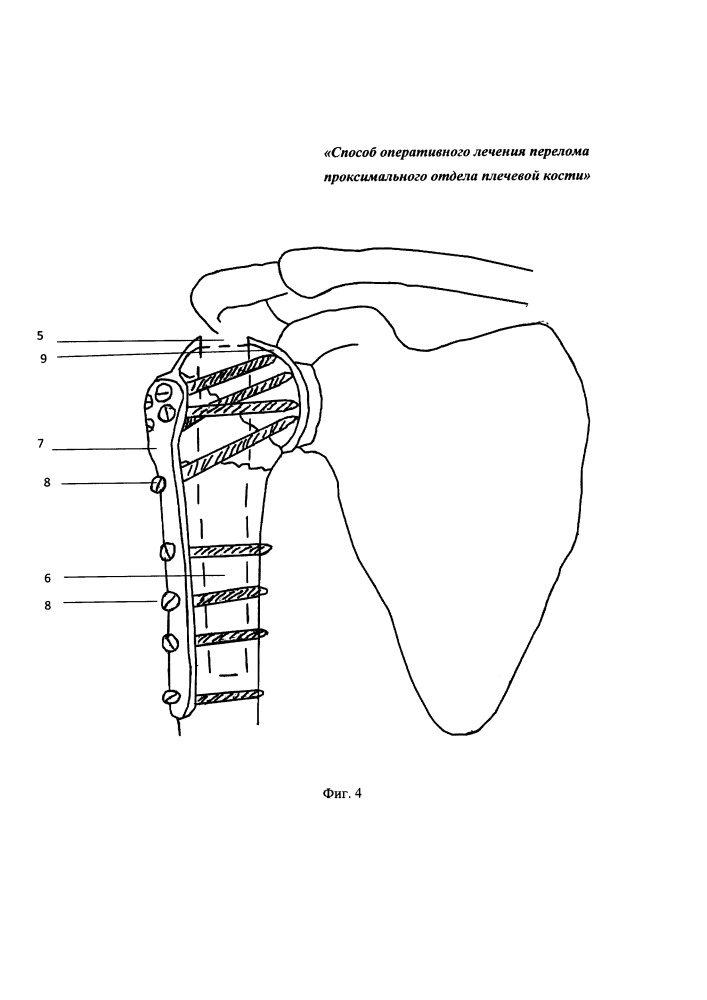 Способ хирургического лечения перелома проксимального отдела плечевой кости (патент 2652573)