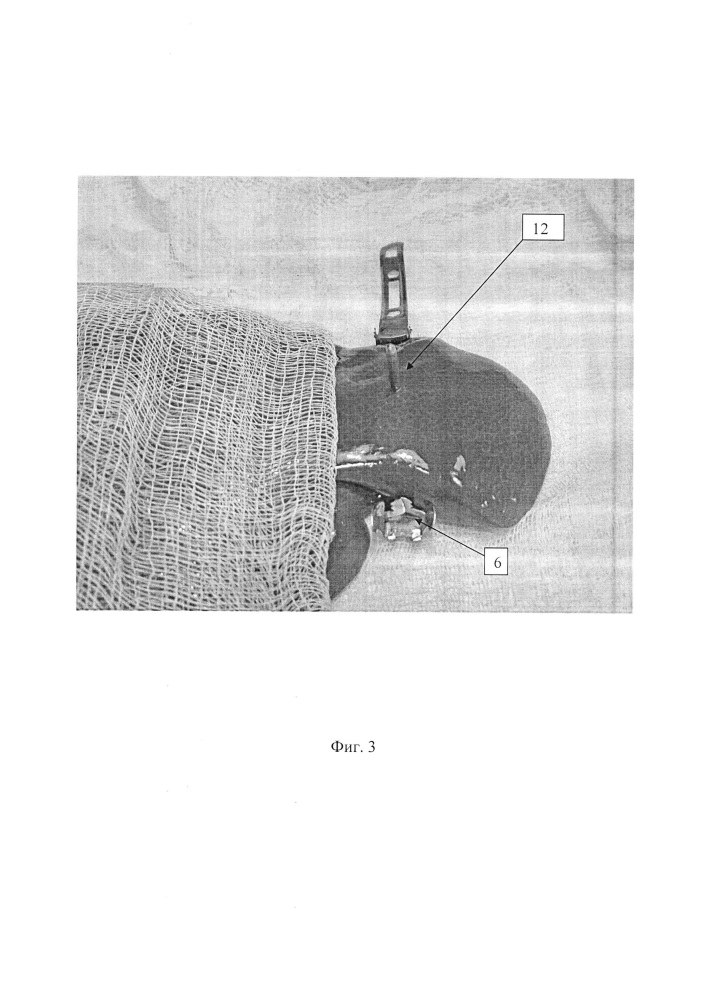 Способ фиксации печеночной ткани и зажим для печени (патент 2641165)