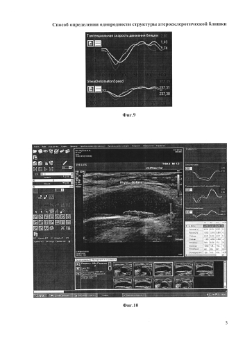 Способ определения однородности структуры атеросклеротической бляшки (патент 2584135)