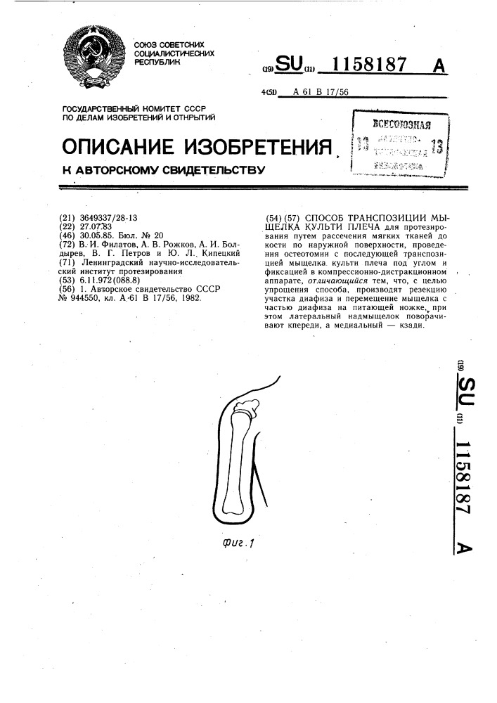 Способ транспозиции мыщелка культи плеча (патент 1158187)