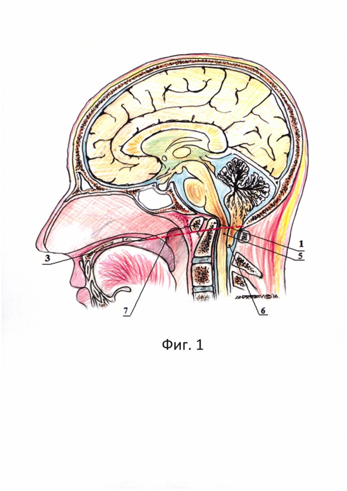 Способ лечения инвагинированного зубовидного отростка с2 позвонка, сочетающегося с мальформацией киари i типа (патент 2620888)