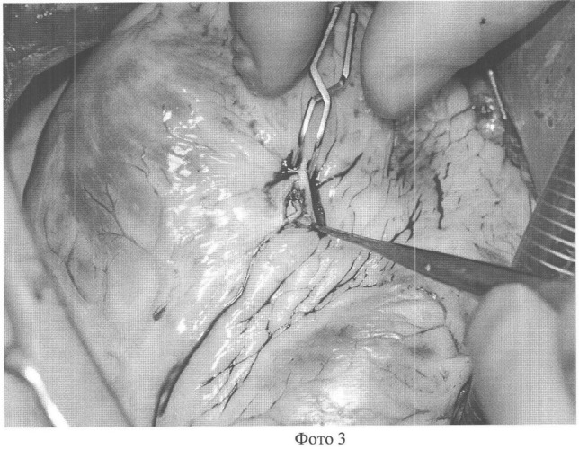 Модифицированный микрососудистый зажим для наложения анастомоза при коронарном шунтировании на работающем сердце (патент 2360626)
