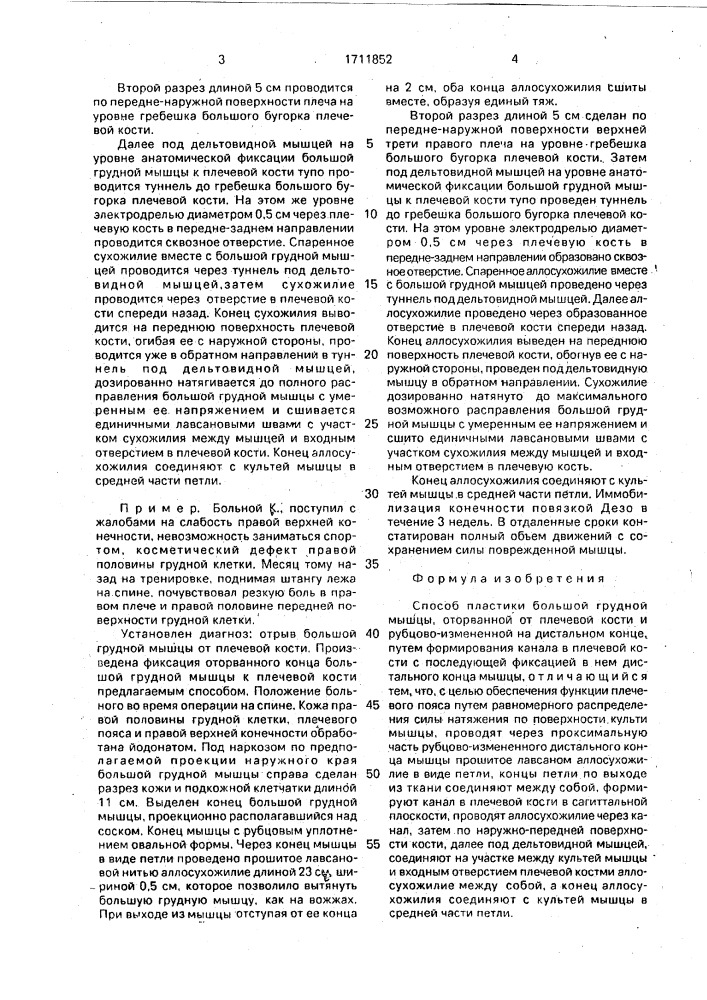 Способ пластики большой грудной мышцы, оторванной от плечевой кости и рубцово-измененной на дистальном конце (патент 1711852)