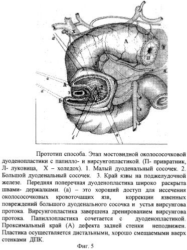 Способ хирургического лечения низких осложненных пенетрацией и кровотечением гигантских дуоденальных язв (патент 2259169)