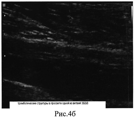 Способ ультразвуковой диагностики начальных этапов формирования тромбозов глубоких вен голени в раннем послеоперационном периоде (патент 2547072)