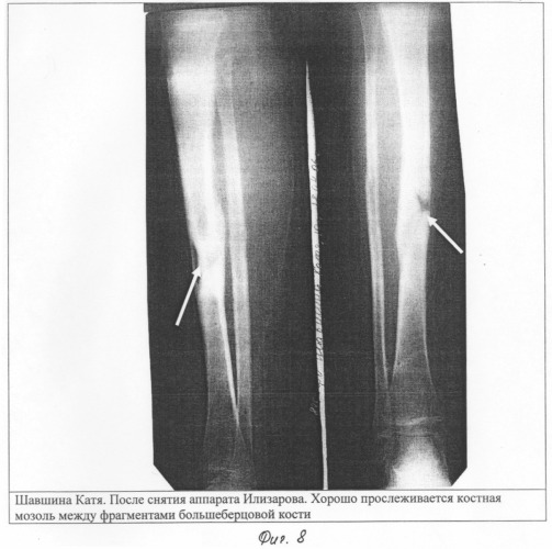 Способ лечения переломов длинных трубчатых костей (патент 2311155)