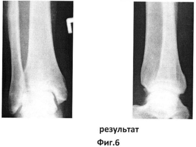 Способ закрытой управляемой динамической аппаратной репозиции переломовывихов в голеностопном суставе при их внутрисуставной костной интерпозиции (патент 2415656)