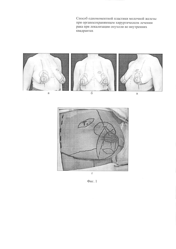 Способ одномоментной пластики молочной железы при органосохраняющем хирургическом лечении рака при локализации опухоли во внутренних квадрантах (патент 2649530)