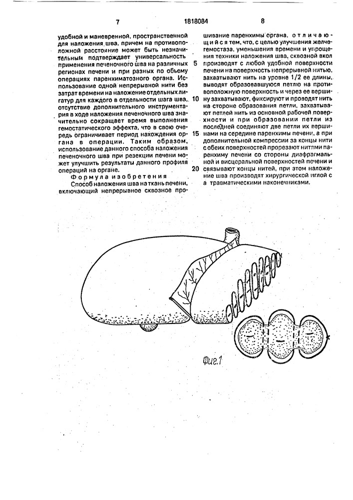 Способ наложения шва на ткань печени (патент 1818084)