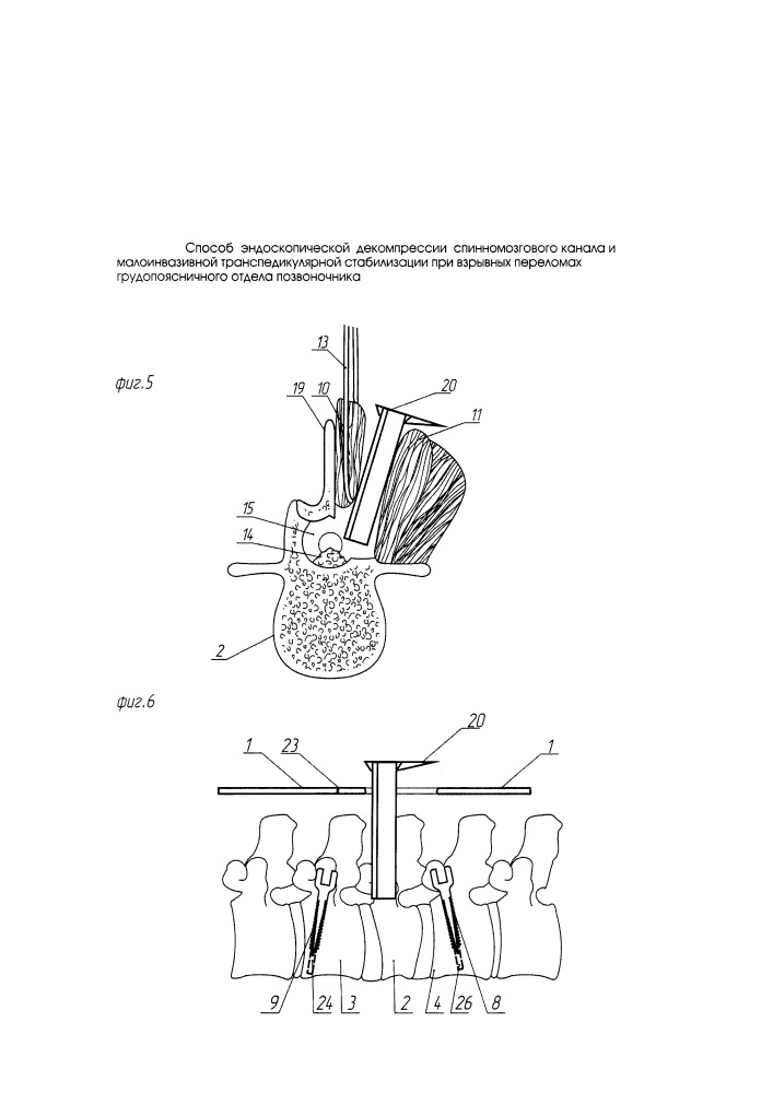 Способ эндоскопической декомпрессии спинномозгового канала и малоинвазивной транспедикулярной стабилизации при взрывных переломах грудопоясничного отдела позвоночника (патент 2649826)