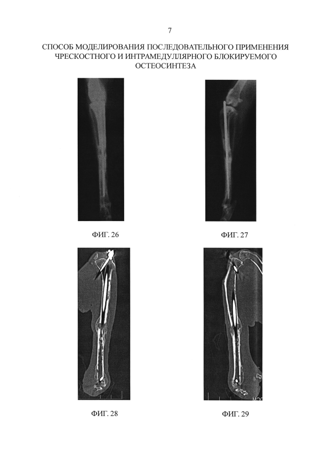 Способ моделирования последовательного применения чрескостного и интрамедуллярного блокируемого остеосинтеза (патент 2593583)