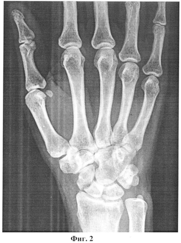Способ оперативного лечения повреждения ладьевидной кости кисти (патент 2552915)