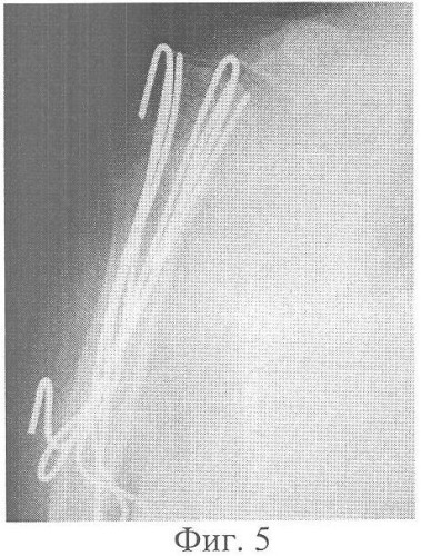 Способ хирургического лечения оскольчатых переломов проксимального отдела плечевой кости напряженными спицами (патент 2357692)