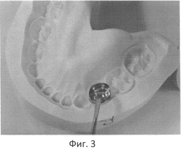 Способ реставрации дефекта временного зуба стандартной стальной коронкой в условиях анестезиологического пособия (патент 2554215)