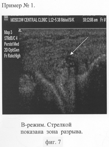 Способ комплексной ультразвуковой диагностики повреждения внутреннего мениска коленного сустава в области тела и переднего рога (патент 2305493)