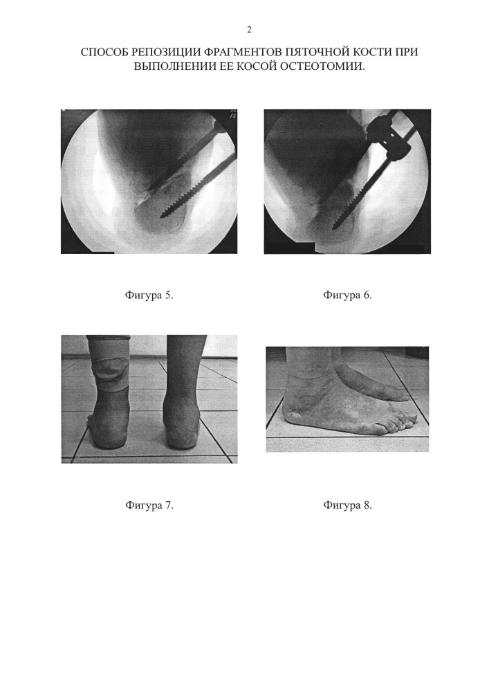 Способ репозиции фрагментов пяточной кости при выполнении ее косой остеотомии (патент 2661705)