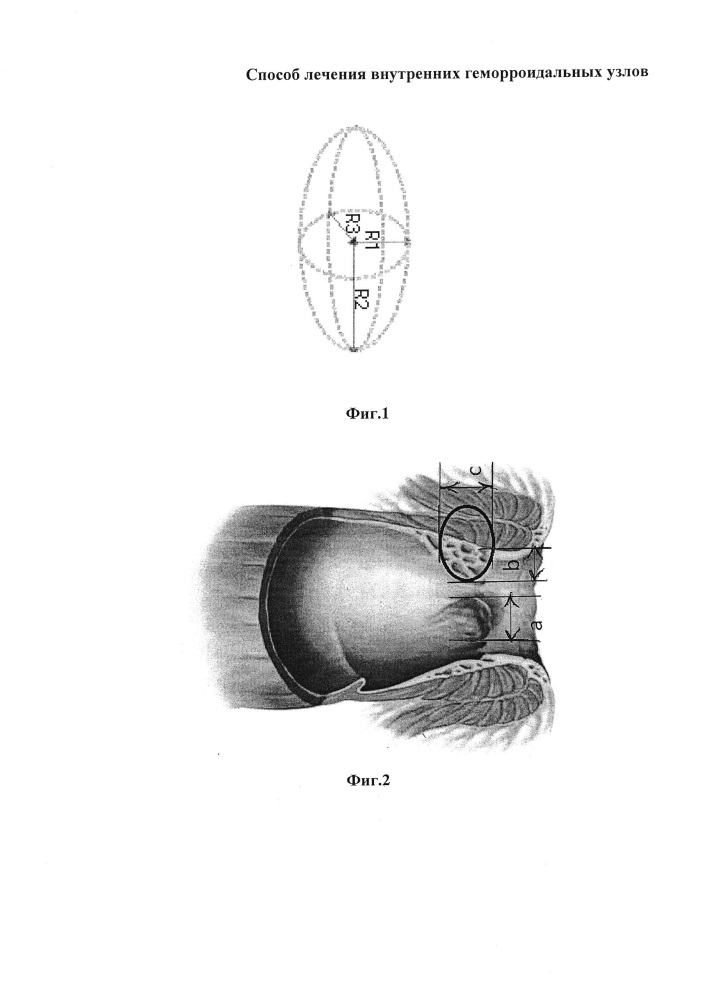 Способ лечения внутренних геморроидальных узлов (патент 2620755)