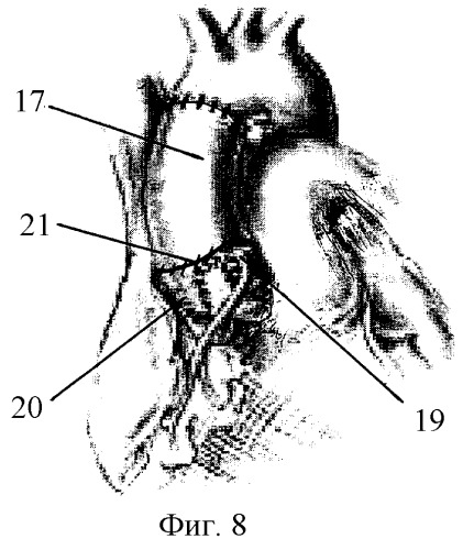Способ хирургического лечения аневризм корня аорты с сохранением собственного клапана (патент 2294703)