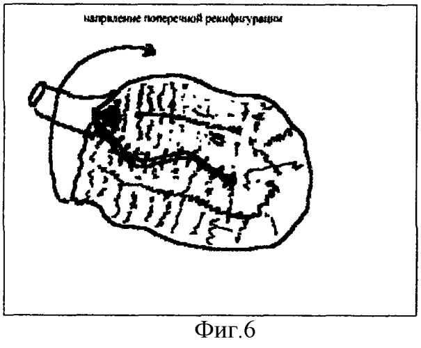 Способ гетеротопической пластики мочевого пузыря (патент 2286098)