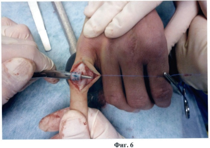 Способ устранения тендо-десмогенной сгибательной контрактуры пальца кисти (патент 2459593)