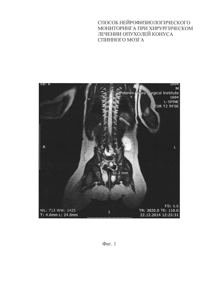 Способ нейрофизиологического мониторинга при хирургическом лечении липом конуса спинного мозга (патент 2621411)