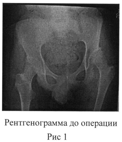 Способ остеотомии таза при лечении дисплазии вертлужной впадины у детей с дцп (патент 2501532)