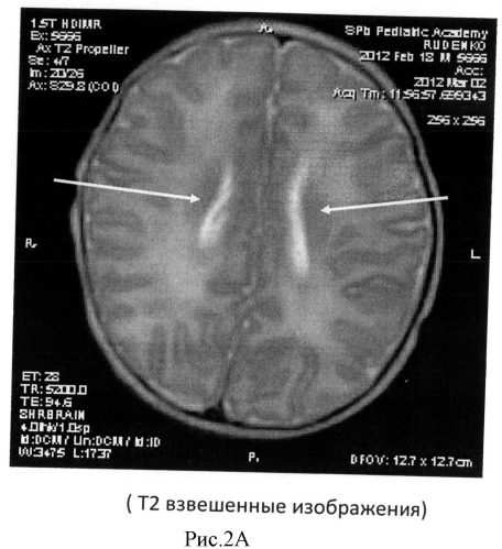 Способ определения зрелости церебральных структур у недоношенных новорожденных (патент 2491888)