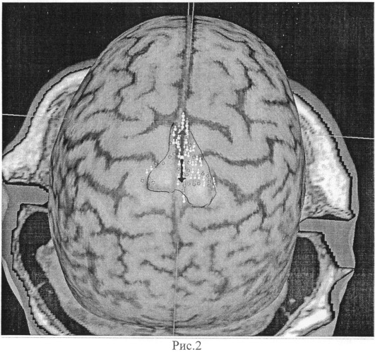 Способ выявления в коре головного мозга сенсомоторных зон, ответственных за локомоцию (патент 2504329)