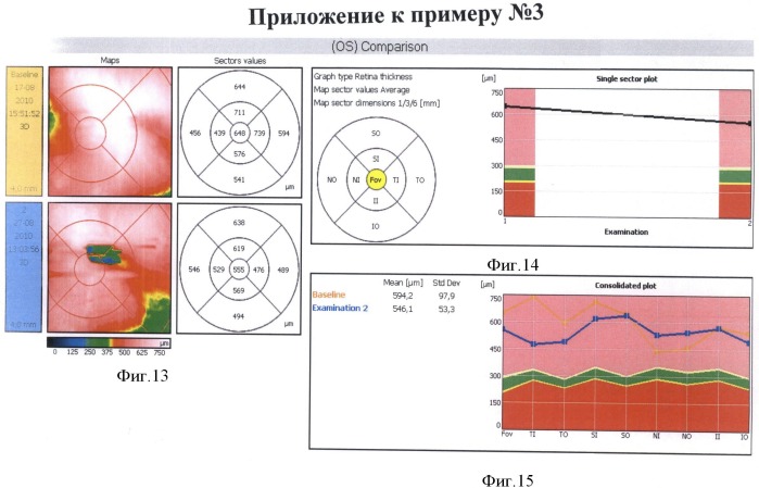 Способ комбинированного лечения диабетического диффузного макулярного отека (патент 2486878)