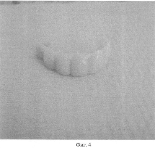 Способ изготовления временных протезов (патент 2355354)