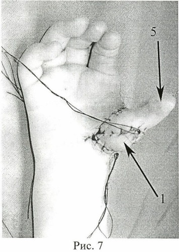 Способ реконструкции первого пальца кисти у детей с врожденной гипоплазией первого пальца кисти (патент 2471444)
