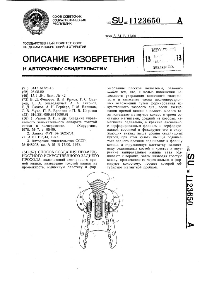 Способ создания промежностного искусственного заднего прохода (патент 1123650)