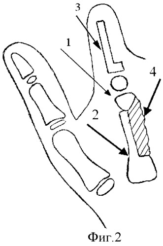 Способ восстановления пальцев при врожденных пороках кисти (патент 2316277)