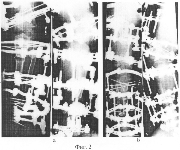 Способ реконструкции нижних конечностей у больных с эпифизарной дисплазией (патент 2290892)