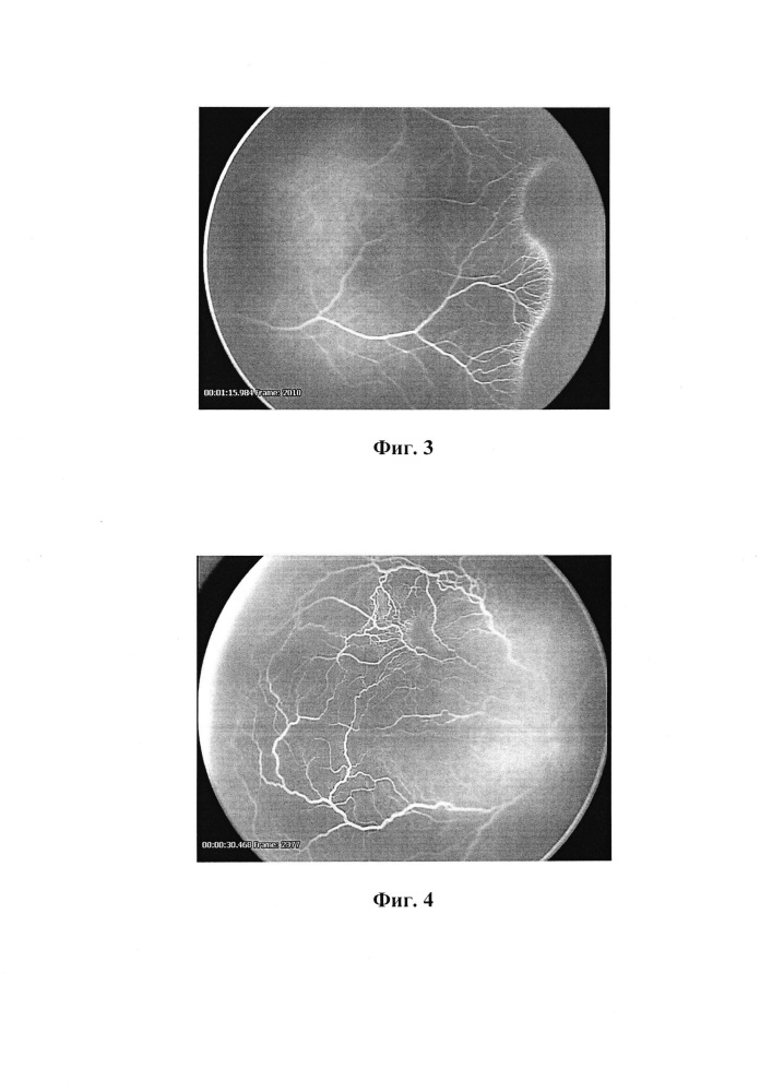 Способ прогнозирования течения i-iii стадий активной ретинопатии недоношенных на основании данных флюоресцентной ангиографии (патент 2666268)