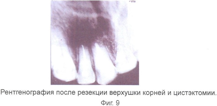 Гель для регенерации костной ткани (патент 2360663)