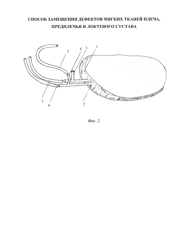 Способ замещения дефектов мягких тканей плеча, предплечья и локтевого сустава (патент 2621275)