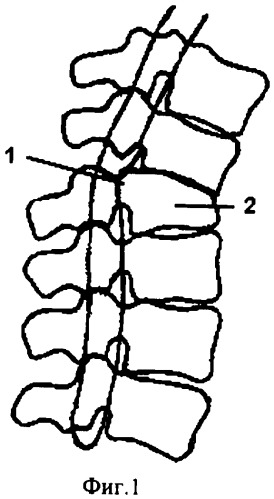 Способ хирургического лечения последствий переломов позвоночника (патент 2279859)