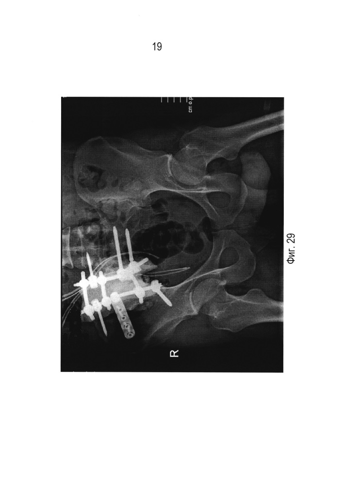 Устройство для реконструкции костей таза (патент 2626122)
