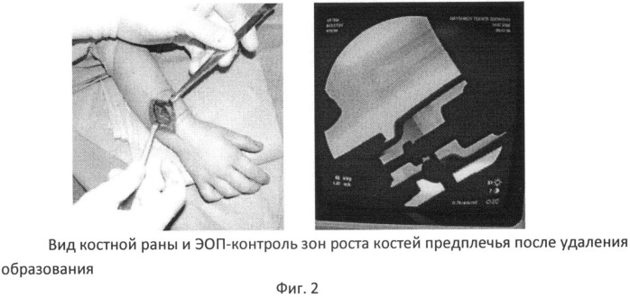 Способ оперативного лечения формирующейся косорукости у детей младшего возраста при экзостозной хондродисплазии (патент 2504340)