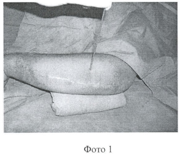Способ лечения несросшихся переломов и ложных суставов длинных костей (патент 2359632)