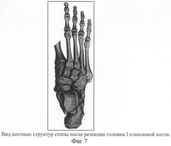 Способ формирования культи стопы (патент 2308244)