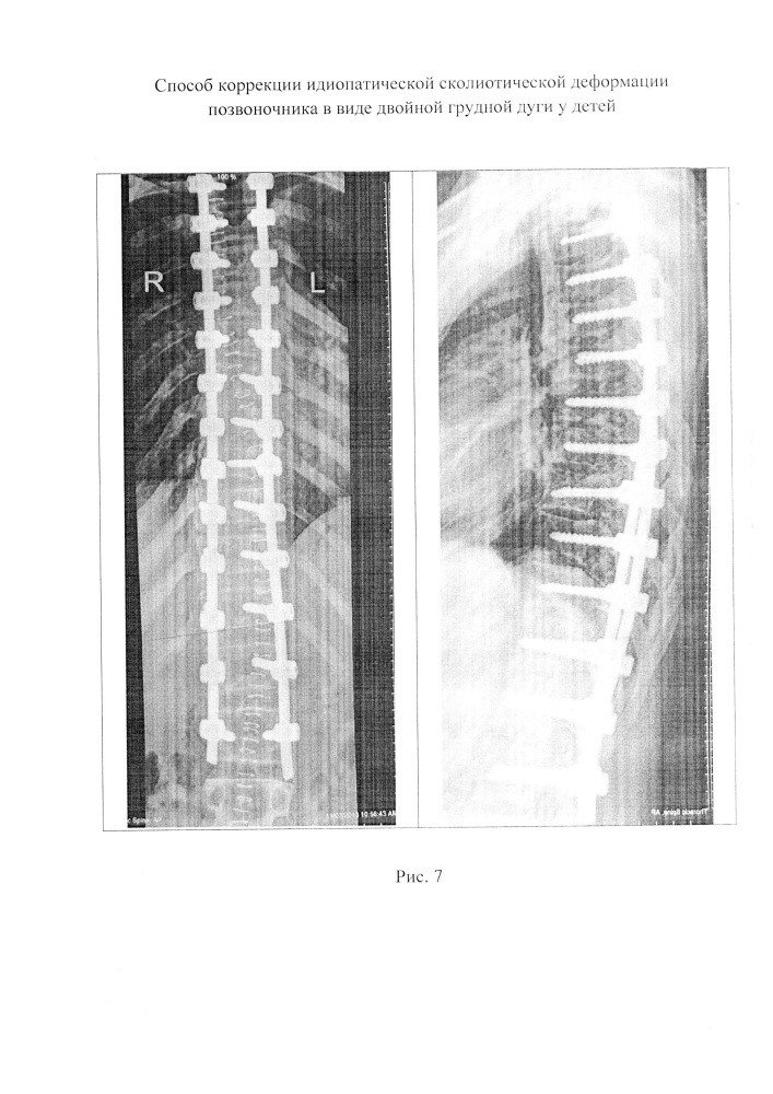 Способ коррекции идиопатической сколиотической деформации позвоночника в виде двойной грудной дуги у детей (патент 2651111)