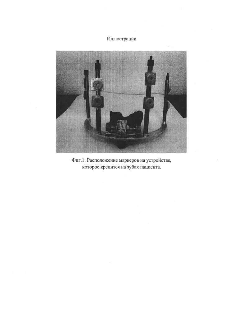 Способ маркировки головы пациента при работе с интраоперационной безрамной нейронавигацией (патент 2607404)