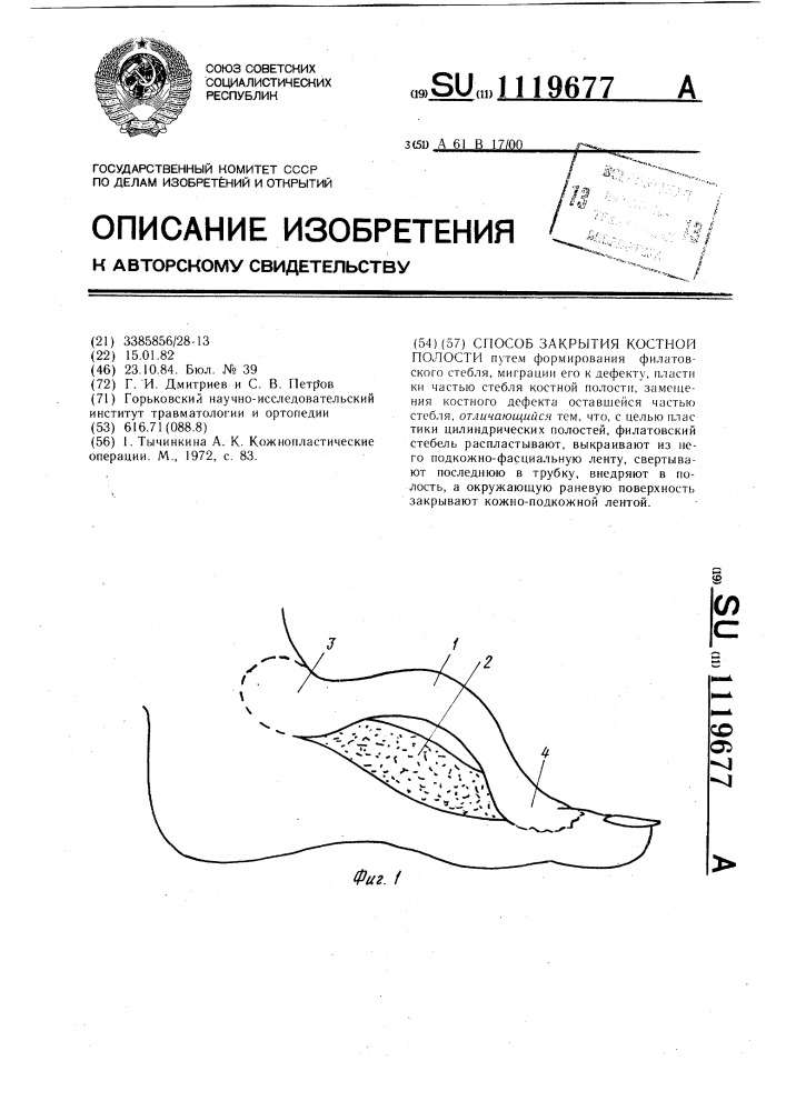 Способ закрытия костной полости (патент 1119677)