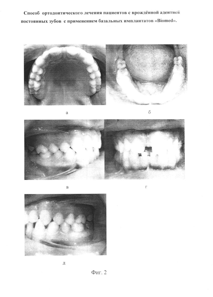 Способ ортодонтического лечения пациентов с врождённой адентией постоянных зубов с применением базальных имплантатов "biomed" (патент 2638286)