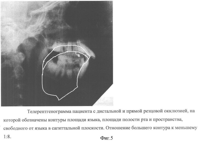 Способ диагностики аномалий зубочелюстной системы (патент 2360604)