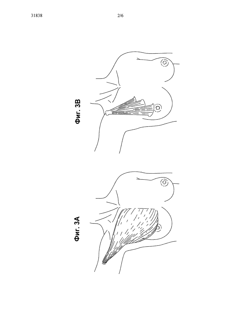 Наполняемая оболочка для мягкого эндопротеза с разными поверхностями сцепления (патент 2645272)